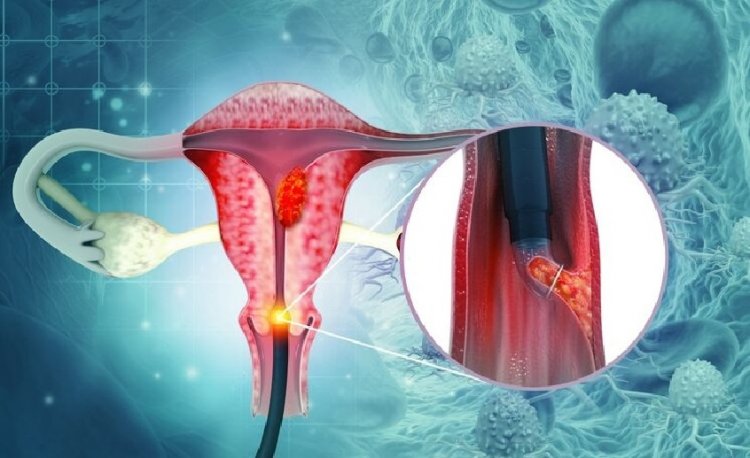 भारत में हर 8 मिनट में सर्वाइकल कैंसर से एक महिला की मौत: AIIMS–ICMR रिपोर्ट